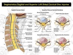 Cervical Degenerative Disc Disease with Left Disc Injuries