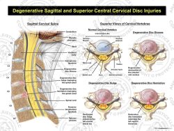 Cervical Degenerative Disc Disease with Central Disc Injuries