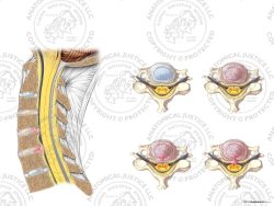 Cervical Degenerative Disc Disease with Central Disc Injuries – No Text