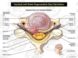 Left Cervical Degenerative Disc Herniation