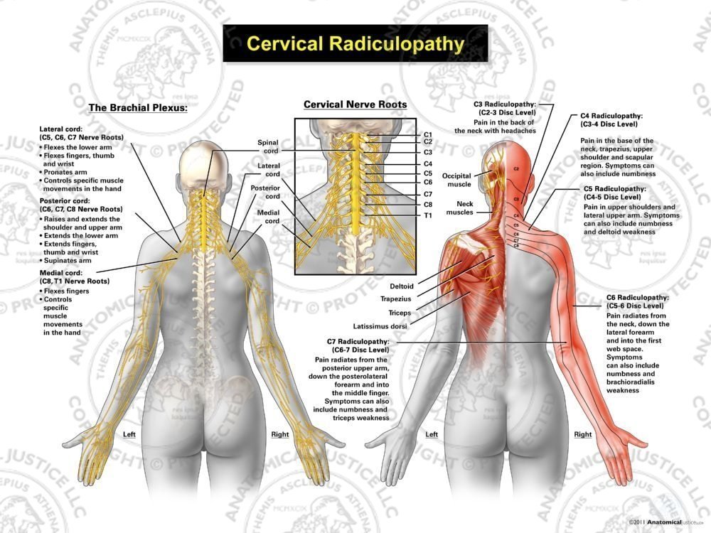 Cervical Radiculopathy Pinched Nerve In Neck Symptoms Treatment