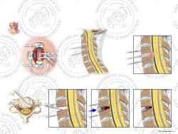 C3-4 Anterior Cervical Discectomy and Artificial Disc Placement – No Text