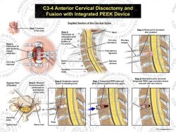 C3-4 Anterior Cervical Discectomy and Fusion with Integrated PEEK Device