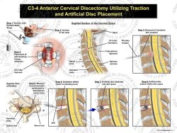 Female C3-4 Anterior Cervical Discectomy Utilizing Traction and Artificial Disc Placement
