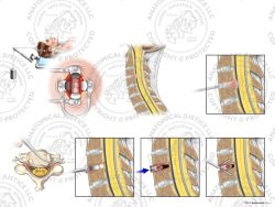 Female C3-4 Anterior Cervical Discectomy Utilizing Traction and Fusion with Integrated PEEK Device – No Text