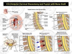 C3-5 Anterior Cervical Discectomy and Fusion with Bone Graft