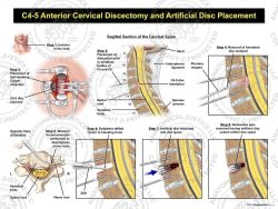 C4-5 Anterior Cervical Discectomy and Artificial Disc Placement