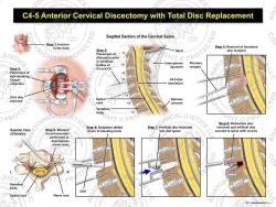 C4-5 Anterior Cervical Discectomy and Total Disc Replacement