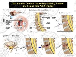 Female C3-4 Anterior Cervical Discectomy Utilizing Traction and Fusion with PEEK Implant