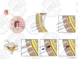 C5-6 Anterior Cervical Discectomy and Artificial Disc Placement – No Text