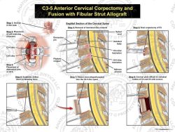 C3-5 Anterior Cervical Corpectomy and Fusion with Fibular Strut Graft
