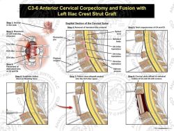 C3-6 Anterior Cervical Corpectomy and Fusion with Fibular Strut Graft