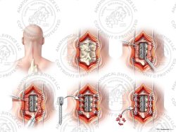 C3-6 Posterior Cervical Laminectomy and Fusion – No Text
