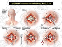 C5-6 Posterior Cervical Laminectomy and Fusion