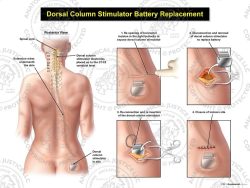 Female Right Cervical Dorsal Column Stimulator Battery Replacement