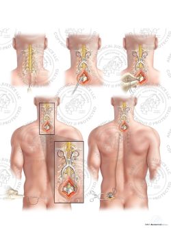 Male Left Dorsal Column Stimulator Insertion – No Text