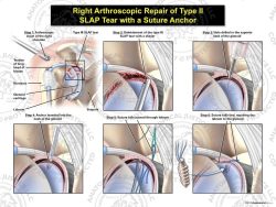 Right Arthroscopic Repair of Type III SLAP Tear with a Suture Anchor