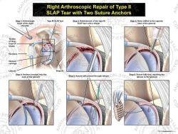 Right Arthroscopic Repair of Type III SLAP Tear with Two Suture Anchors