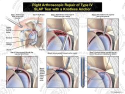 Right Arthroscopic Repair of Type IV SLAP Tear with a Knotless Anchor
