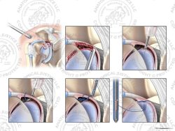 Right Arthroscopic Repair of Type IV SLAP Tear with a Knotless Anchor – No Text