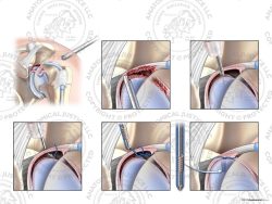 Left Arthroscopic Repair of Type IV SLAP Tear with a Knotless Anchor – No Text
