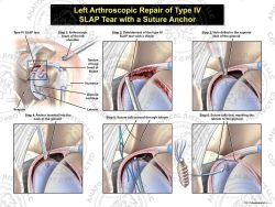 Left Arthroscopic Repair of Type IV SLAP Tear with a Suture Anchor