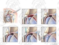 Left Arthroscopic Repair of Type IV SLAP Tear with a Suture Anchor – No Text