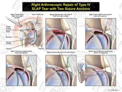 Right Arthroscopic Repair of Type IV SLAP Tear with Two Suture Anchors