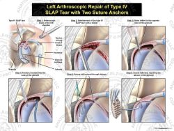 Left Arthroscopic Repair of Type IV SLAP Tear with Two Suture Anchors