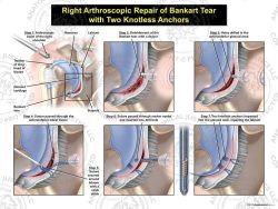 Right Arthroscopic Repair of Bankart Lesion with Two Knotless Anchors