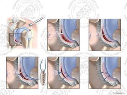 Left Arthroscopic Repair of Bankart Lesion with Two Suture Anchors – No Text