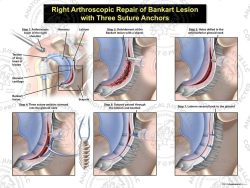 Right Arthroscopic Repair of Bankart Lesion with Three Suture Anchors