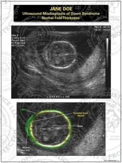 Ultrasound Misdiagnosis of Down Syndrome Nuchal Fold Thickness