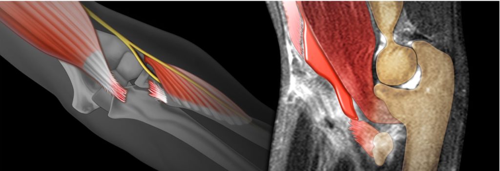 distal biceps rupture illustration alongside a radiological colorization of the same