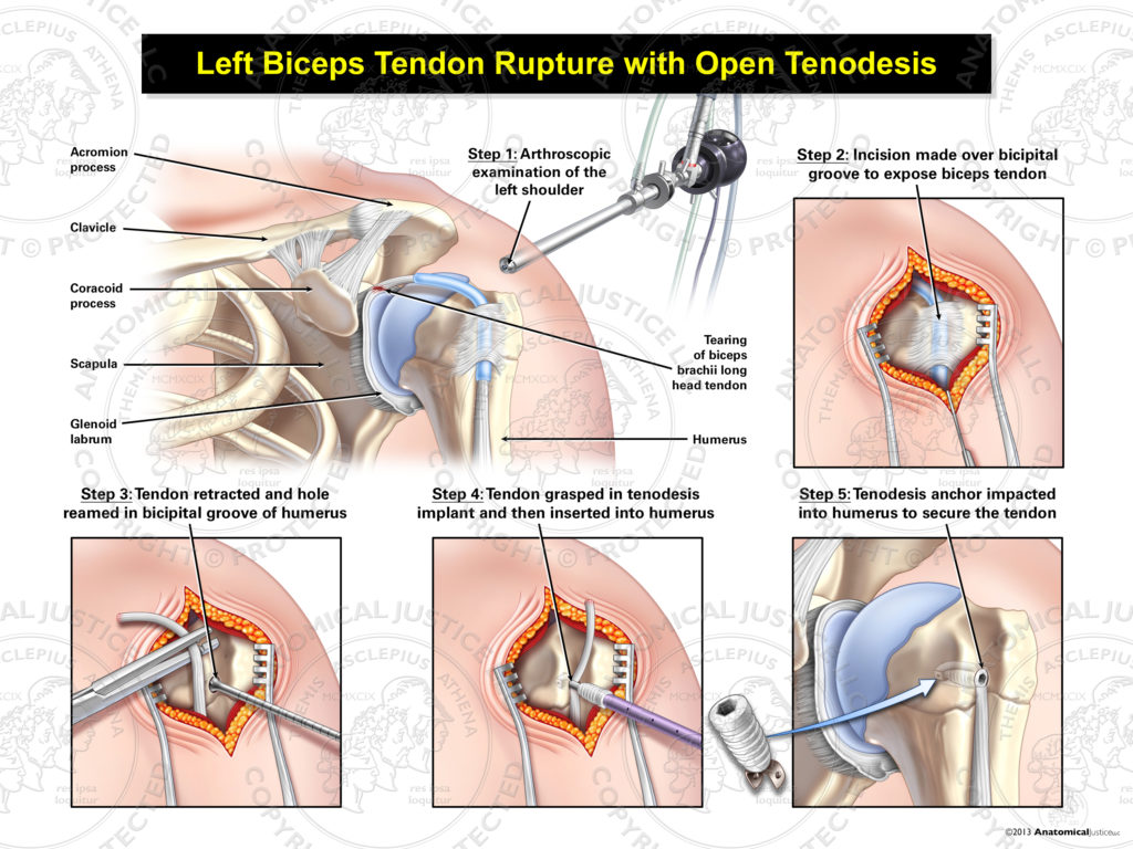 Surgical repair of the biceps longhead tendon