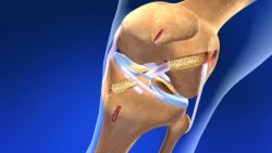 ACL Reconstruction Animation