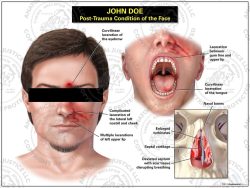 Facial Lacerations with Septal Injury