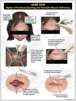 Repair of Forehead Scarring and Frontalis Muscle Deficiency
