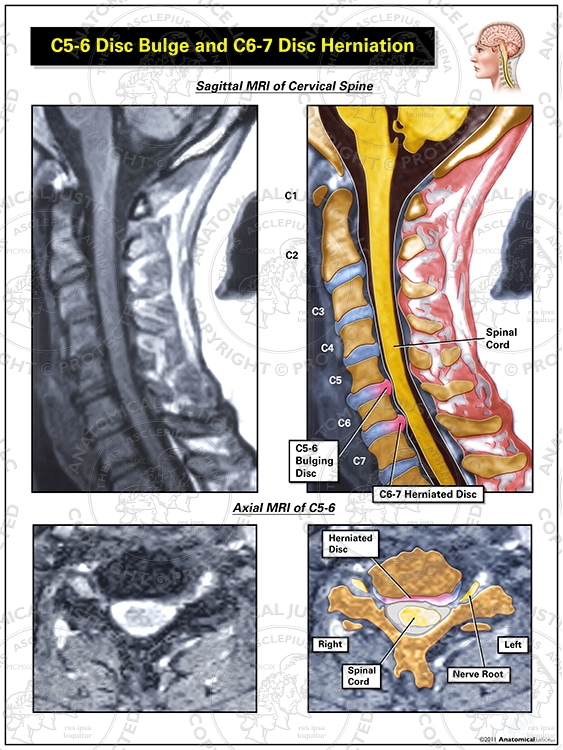 C5-6 Disc Bulge and C6-7 Disc Herniation