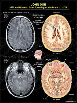 MRI and Bilateral Axon Shearing of the Brain