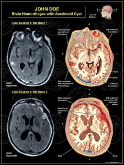 Brain Hemorrhages with Arachnoid Cyst