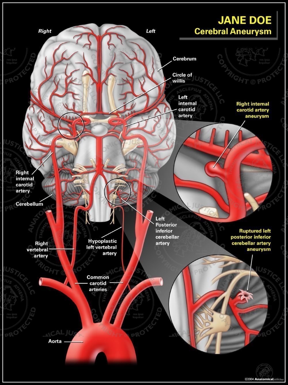Posterior Cerebral Artery Aneurysm