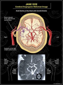 Cerebral Angiogram Reformat Image