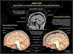 Normal Brain vs. Atrophy Secondary to Axon Shearing Injury