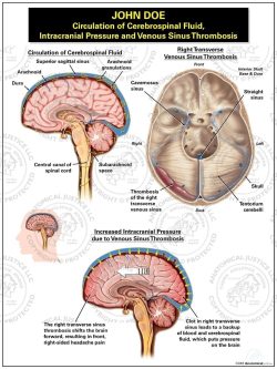 Circulation of Cerebrospinal Fluid, Intracranial Pressure, and Venous Sinus Thrombosis