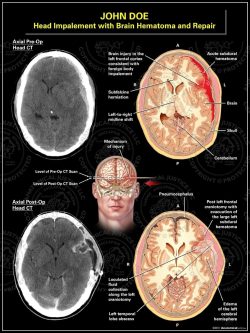 Head Impalement with Brain Hematoma and Repair