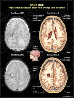 Right Interventricular Brain Hemorrhage and Ischemia