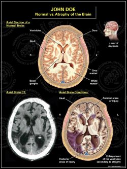Normal vs. Atrophy of the Brain