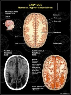 Normal vs. Hypoxic Ischemic Brain