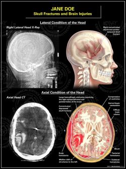 Skull Fractures and Brain Injuries